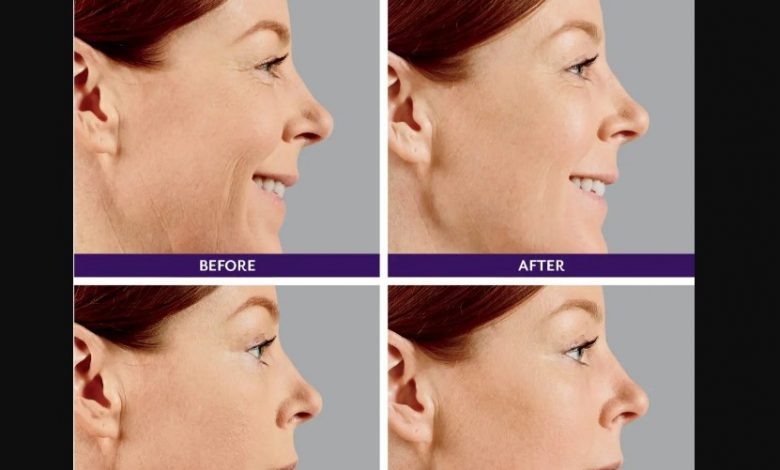 Juvederm treatment