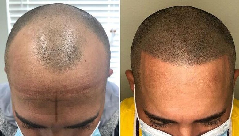 scalp micropigmentation- Know the Benefits and Risks of Scalp Micropigmentation