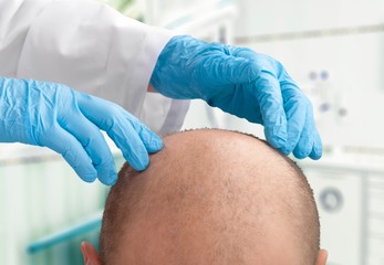 Hair Transplant