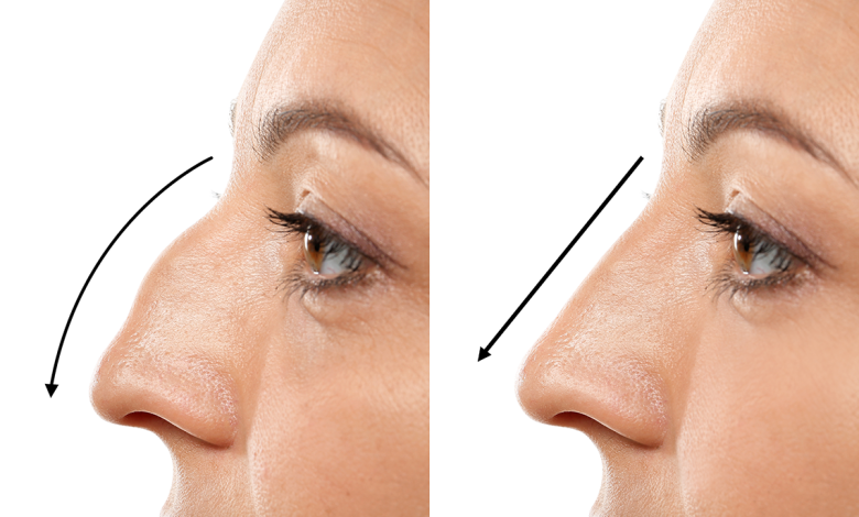 Best Rhinoplasty Uk