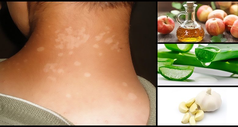 Natural Tips for Tinea Versicolor and Supporting Healthy Skin