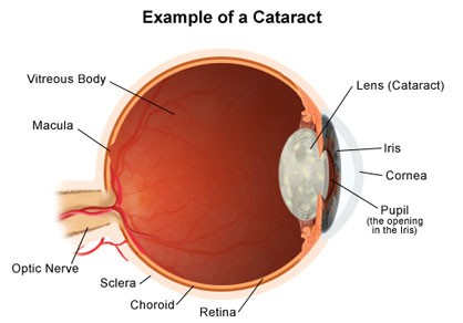 Cataract featured image