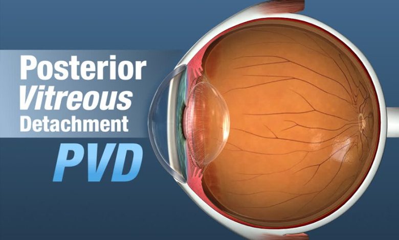 Posterior Vitreous Detachment featured image