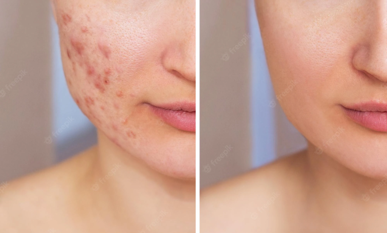 Laser Acne Scar Treatment