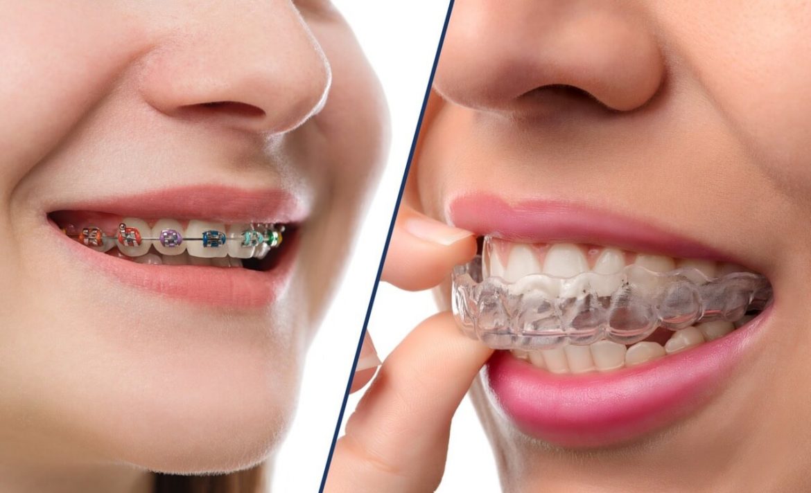 Invisalign Toronto