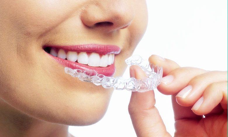 Invisalign Toronto