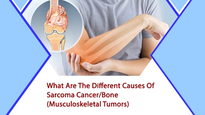 sarcoma