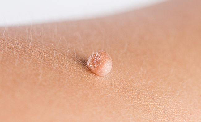 skin tag removal | best skin clinic | skinpase